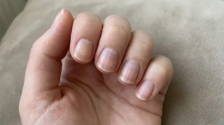 Primo piano di una mano con unghie naturali che mostrano evidenti righe verticali