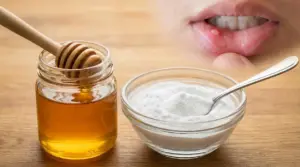 Barattolo di miele e ciotola di bicarbonato accanto alla bocca di una persona con un’afta sul labbro