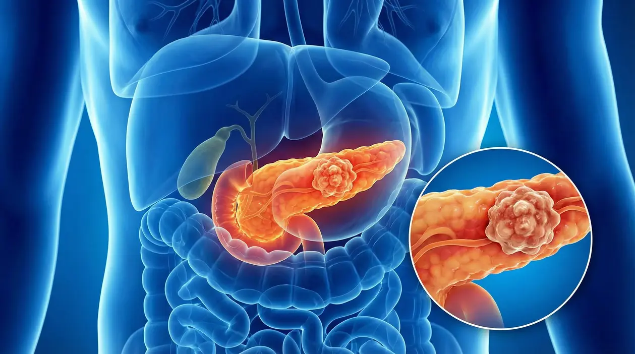 Illustrazione medica del pancreas con evidenza di massa tumorale
