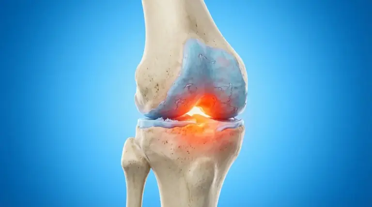 Illustrazione di un’articolazione del ginocchio con cartilagine consumata e area infiammata evidenziata in rosso